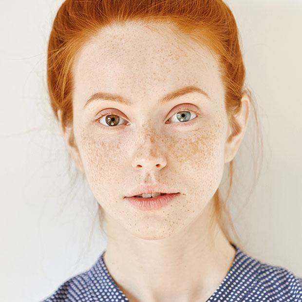 What Do You Know About Heterochromia? - Flower Eye Care